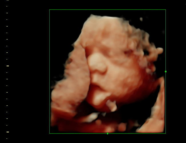 3D ultrasound image at 28 weeks
